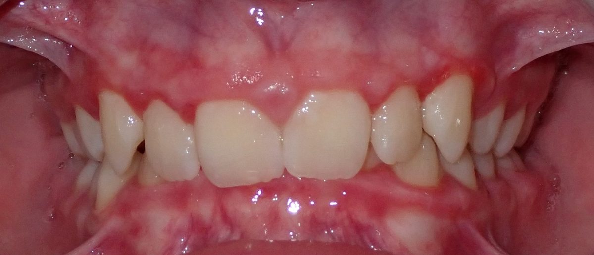 Vivid Smiles patient case 7 before and after treatment comparison before